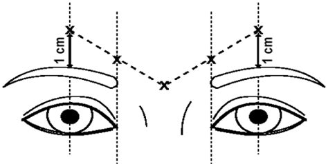 Dysport (Abobotulinumtoxin A Injection): Side Effects, .